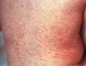 Rash is one of the many symptoms of Chikungunya