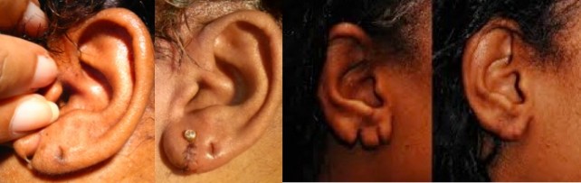 Before and after torn earlobe repair