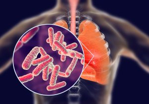 Reported TB cases ‘a little more than usual’ but ‘not a serious problem’ – Chief Medical Officer