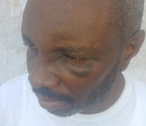 Dominican imprisoned in Antigua to undergo surgery due to alleged beating by prison officers