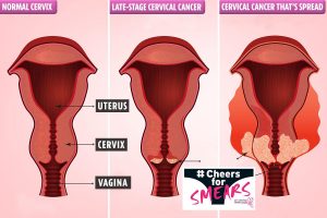 President of Dominica Cancer Society encourages early testing for cervical cancer