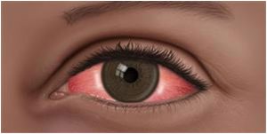 Ophthalmologist diagnoses first COVID-19 conjunctivitis (red/pink eye) case in Dominica