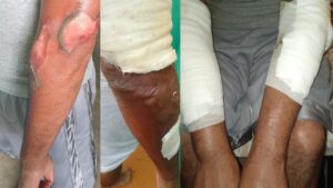 Dominican inmate injured in prison fire in St. Maarten calls for urgent medical care
